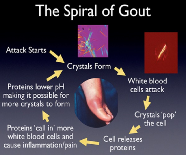 15 Awesome Home Remedies for Gout