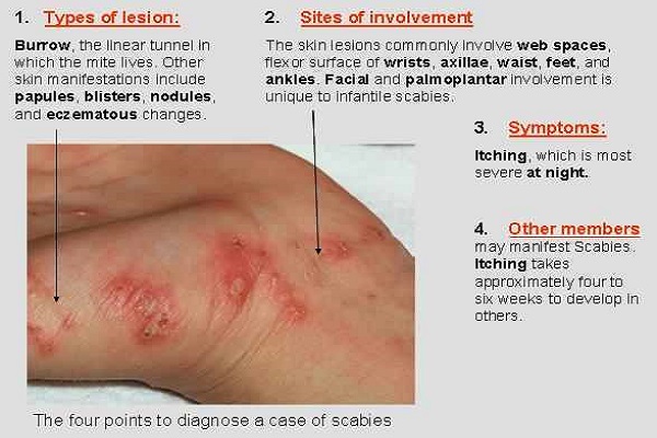 14-effective-home-remedies-against-scabies