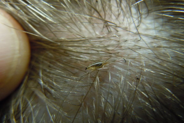 home remedies for treating head lice