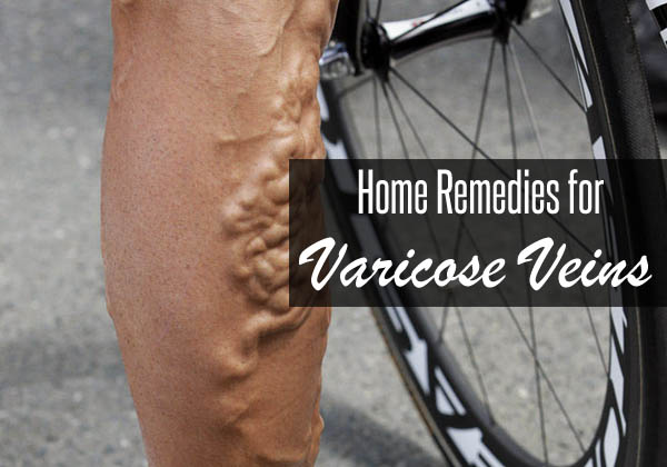 home-remedies-for-varicose-veins